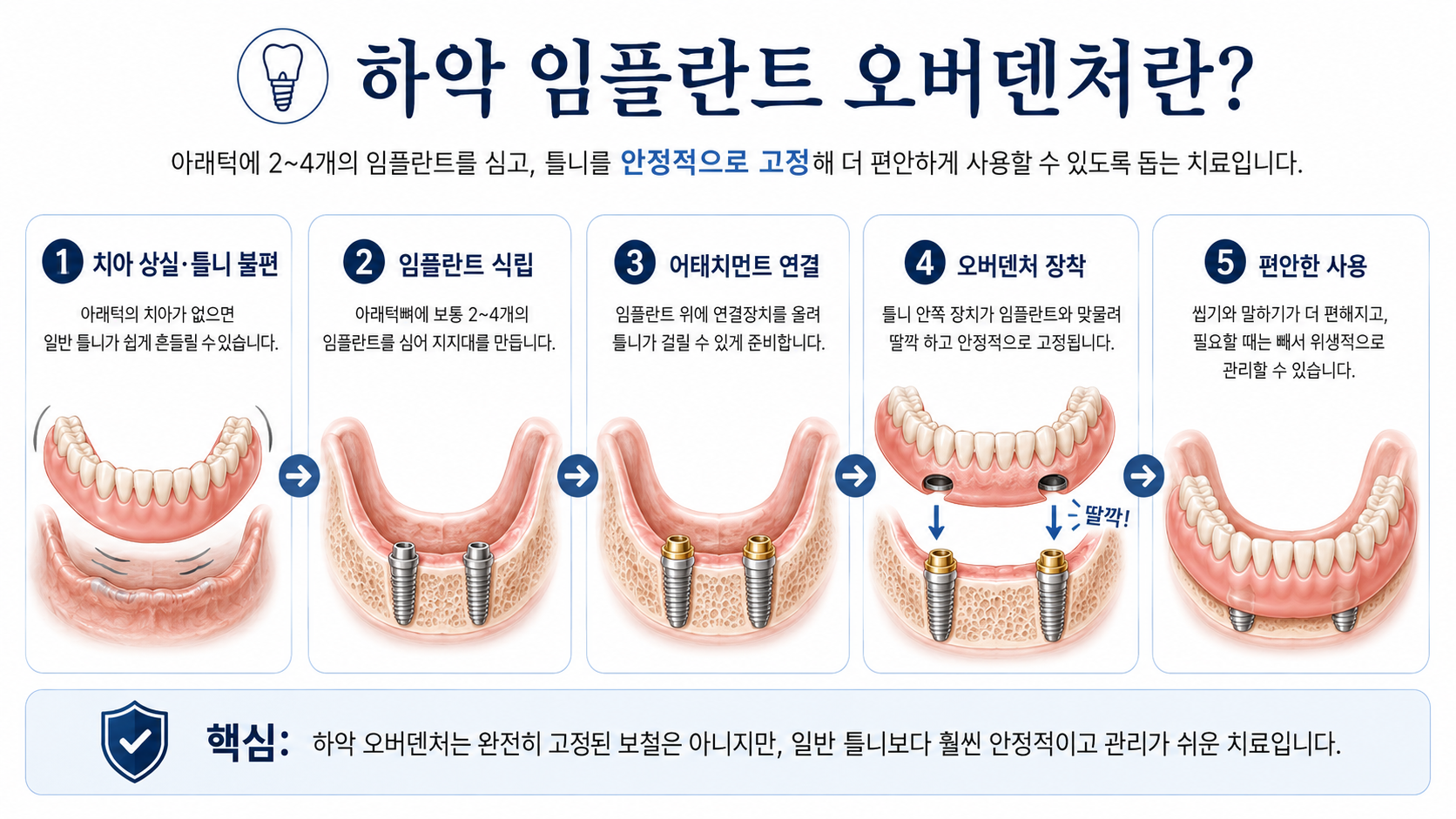하악 임플란트 오버덴처