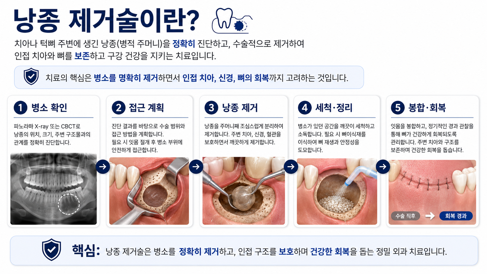 낭종제거술