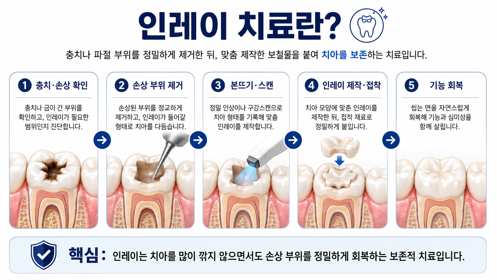 인레이