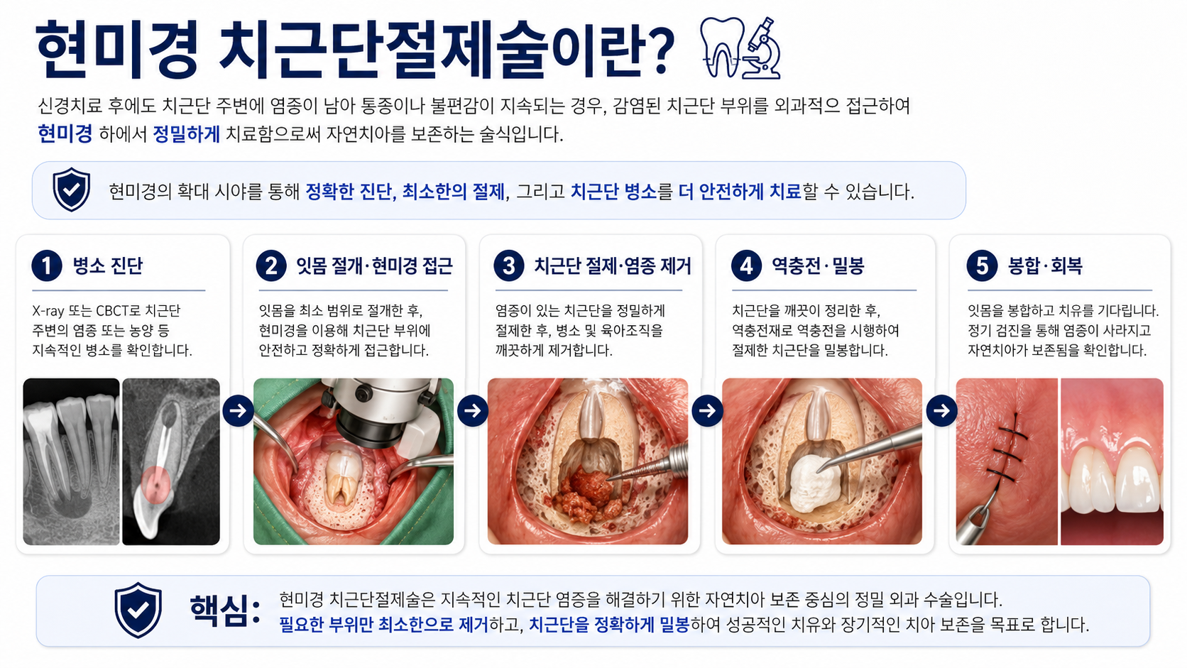 현미경 치근단절제술